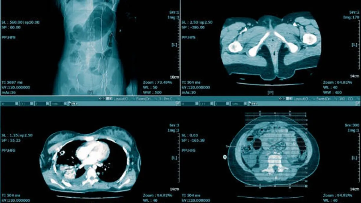 Kidney Stones and Urinary Problems: Understanding CT Urinary Tract Imaging