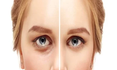 When Should You Consider Lower Eyelid Surgery?