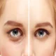 When Should You Consider Lower Eyelid Surgery?