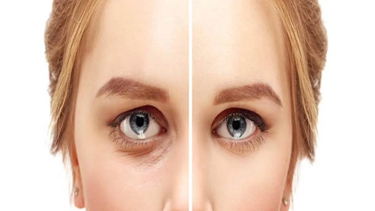 When Should You Consider Lower Eyelid Surgery?
